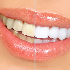 Does Teeth Whitening Really Work? | Glendale, CA