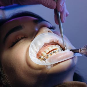 4 Solutions For Orthodontics After Root Canals