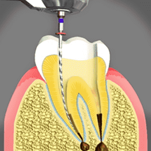 Root Canals treatments in Glendale
